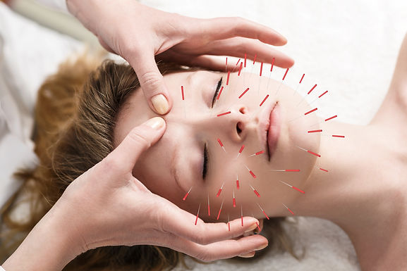 Facial rejuvenation involves inserting acupuncture needles to smooth out wrinkles and tension