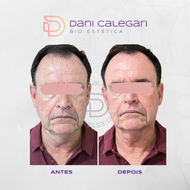 Ultrassom Ultramed Hifu - A Evolução do Ultraformer