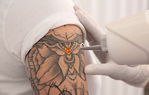 Remoção de Tatuagem.jpg