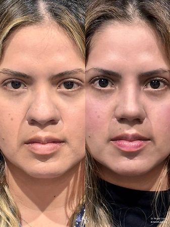 rinoplastia antes y después lima resultado natural