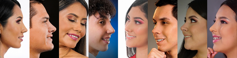 Resultado después de rinoplastia ultrasónica realizada por el Dr. Miguel Dávila en Lima