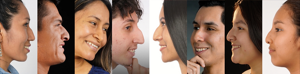 Resultado antes de rinoplastia ultrasónica realizada por el Dr. Miguel Dávila en Lima