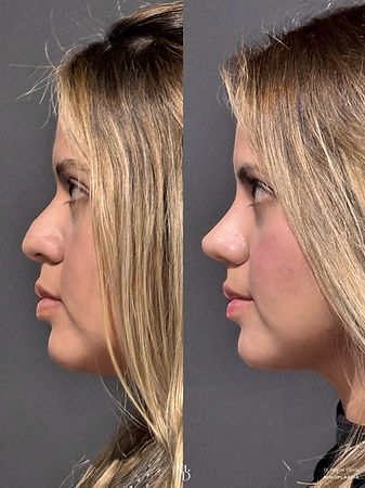 rinoplastia antes y después lima resultado natural