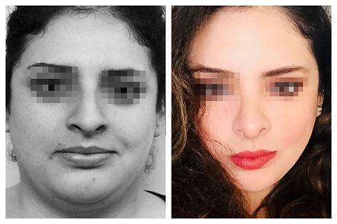 liposuccion de papada Dr. Miguel Davila cirujano plastico