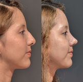 rinoplastia antes y después Lima piel gruesa