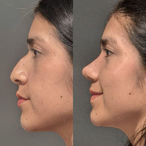 rinoplastia antes y después Lima piel gruesa