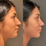 rinoplastia antes y después Lima piel gruesa