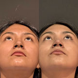 rinoplastia antes y después Lima piel gruesa