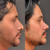 rinoplastia ultrasónica antes después Perú