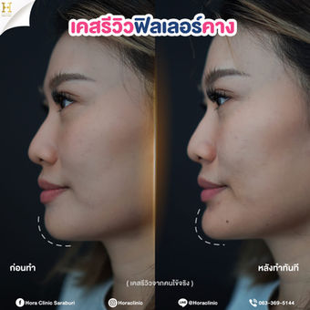 ฟิลเลอร์ filler คาง โฮร่าคลินิก สระบุรี