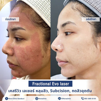 เคสรีวิว laser หลุมสิว microneedle subcision