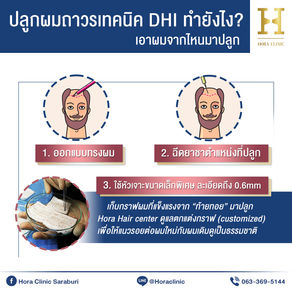 5ขั้นตอนปลูกผมถาวรเทคนิค DHI ทำยังไง? เอาผมจากไหนมาปลูก