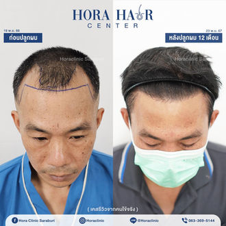ปลูกผมถาวร hairtransplant สระบุรี โฮร่าคลินิก