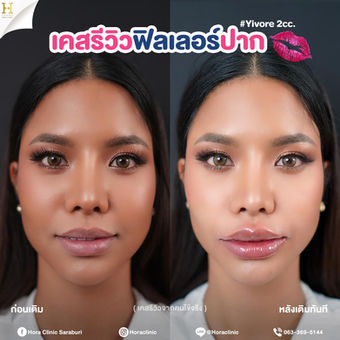 filler ฟิลเลอร์ ปาก lip โฮร่าคลินิก สระบุรี