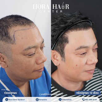 ปลูกผมถาวร hairtransplant สระบุรี โฮร่าคลินิก