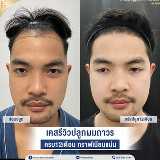 เคสปลูกผมถาวรbefore-after-หน้าตรง.jpg