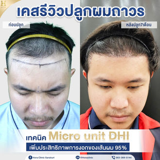 เคสรีวิวหนุ่มวิศวกรปลูกผมถาวรหน้าตรง.jpg