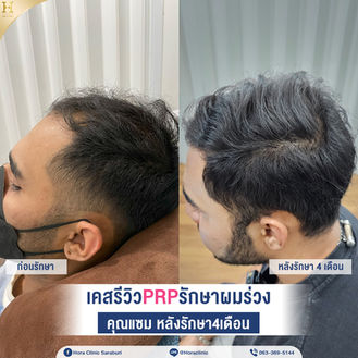 เคสรีวิว prp รักษาผมร่วงผมบาง โฮร่าคลินิก สระบุรี