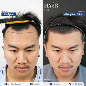 ปลูกผมถาวร hairtransplant สระบุรี โฮร่าคลินิก