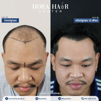 ปลูกผมถาวร hairtransplant สระบุรี โฮร่าคลินิก