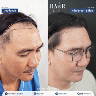 ปลูกผมถาวร hairtransplant สระบุรี โฮร่าคลินิก