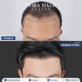 ปลูกผมถาวร hairtransplant สระบุรี โฮร่าคลินิก