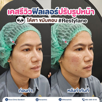 เคสรีวิว ฟิลเลอร์ ใต้ตา ขมับตอบ ร่องแก้ม ฟิลเลอร์คาง 