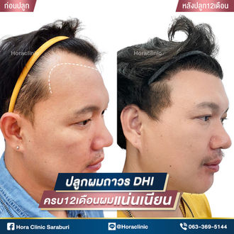ปลูกผม hairtransplant fue dhi สระบุรี
