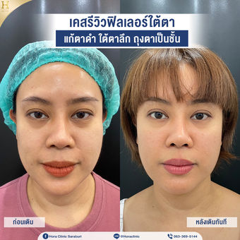 before-ฟิลเลอร์ใต้ตา-พี่ผู้หญิง.jpg
