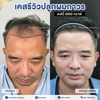 ปลูกผมถาวร hairtransplant สระบุรี โฮร่าคลินิก
