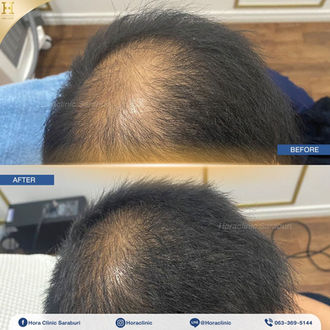 เคสรีวิว รักษาผมร่วง ผมบาง PRP