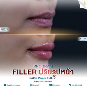 filler ฟิลเลอร์ ปาก lip โฮร่าคลินิก สระบุรี