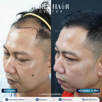 ปลูกผม haritransplant รักษาผมร่วง สระบุรี ภาคกลาง