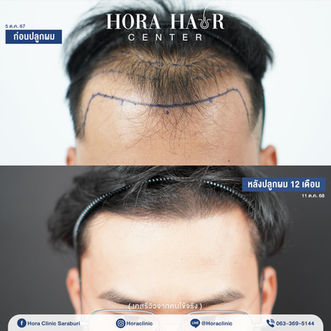 ปลูกผมถาวร hairtransplant สระบุรี โฮร่าคลินิก