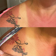 sunburn before and after.jpg