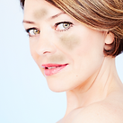 Tratamiento de Melasma