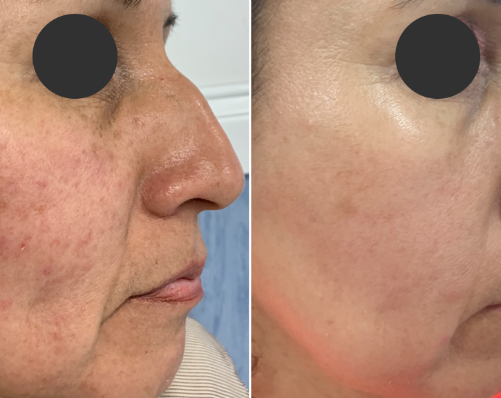 Rejuvenecimiento de la piel