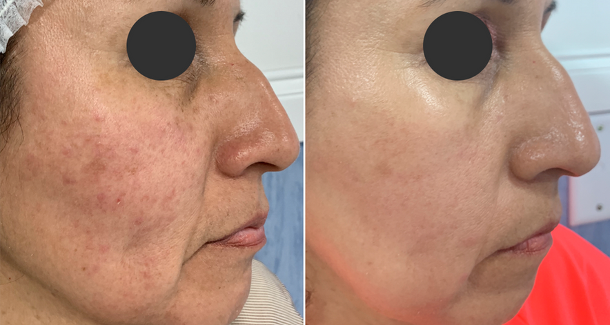 Rejuvenecimiento de la piel