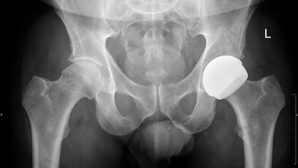 csm_radiograph-ceramic-on-ceramic-resurfacing_201b435c5d.webp