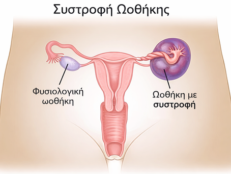 Συστροφή κύστης ωοθήκης
