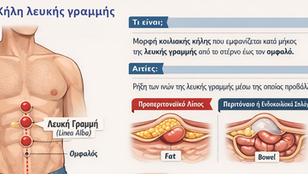 Κήλη λευκής γραμμής