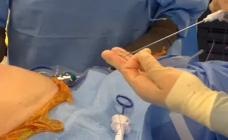 Why Stability Is Key in a High-Performance Laparoscopic Trocar System