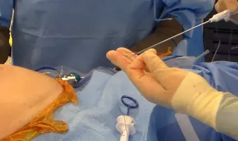 Why Stability Is Key in a High-Performance Laparoscopic Trocar System