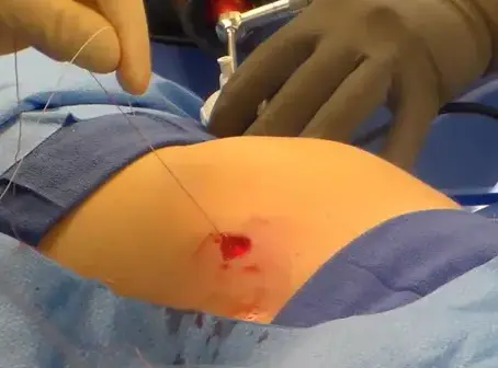 How a Laparoscopic Closure System Reduces General Anesthesia Time