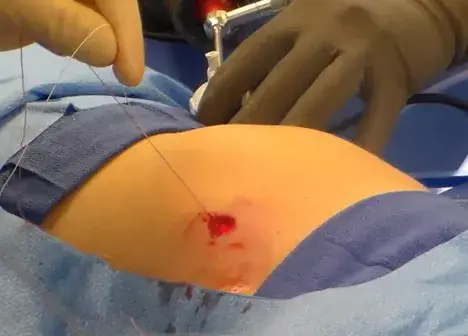 How a Laparoscopic Closure System Reduces General Anesthesia Time