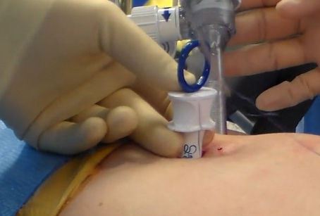 A Technical Review of the Latest Suture Passer Device Innovations