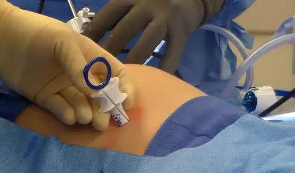 Why Reproducibility Is Paramount in Surgical Fascial Closure