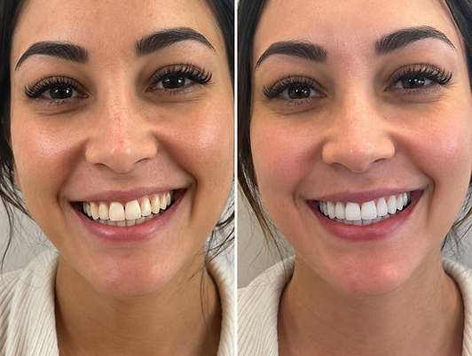 Teeth Whitening, Vini Joseph, Maple.png
