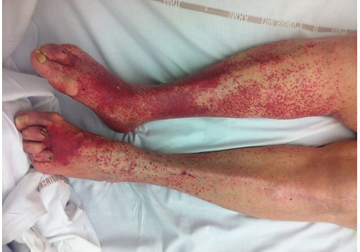 vascularite-purpura.jpg