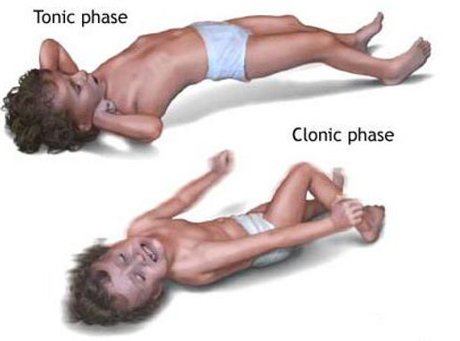 febrileseizure1.jpg
